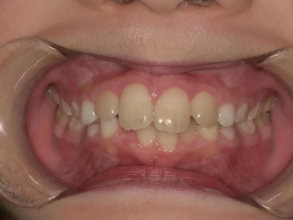 北広島市 プレオルソ 治療前 ガタつき 正面写真