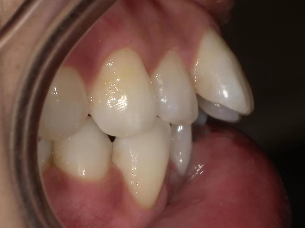 北広島市 矯正歯科 口元の突出感 横顔 治療前