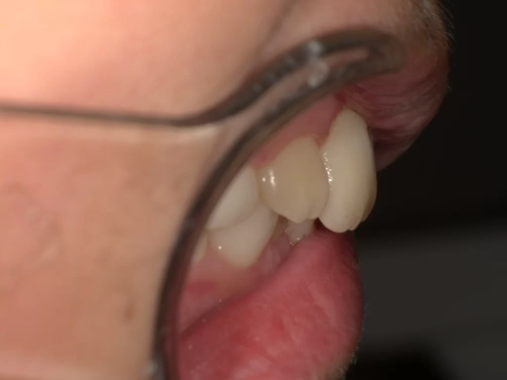 北広島市 プレオルソ 3ヶ月後 歯列拡大 横顔