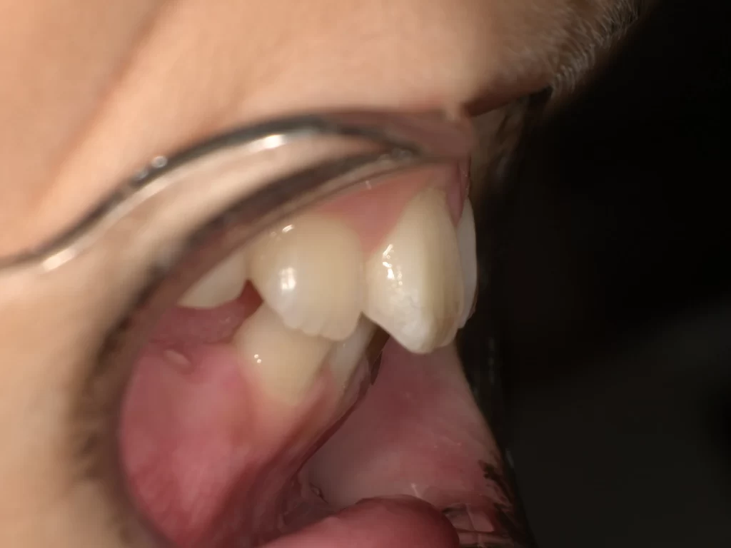 北広島市 小児矯正 10歳 出っ歯 過蓋咬合 治療前 横顔