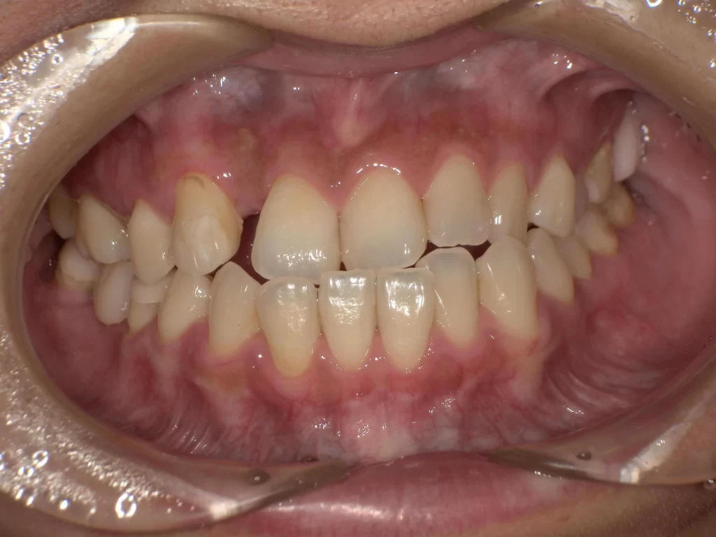 北広島市 部分矯正 前歯の隙間 すきっ歯 治療前 上顎写真