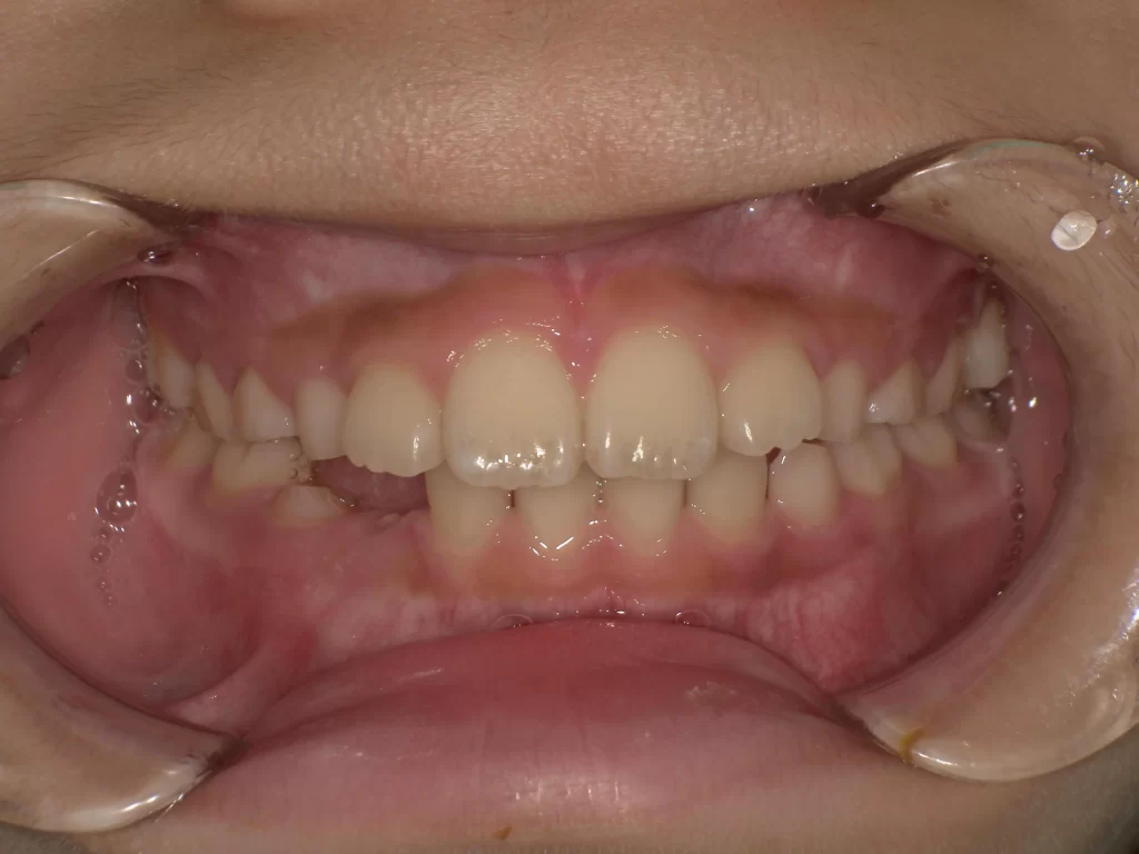 北広島市 子供の矯正 プレオルソ 治療前 深い噛み合わせ 正面