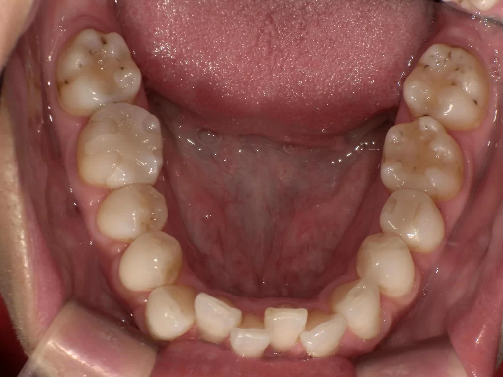 北広島市 矯正歯科 歯列不正 治療前 下顎