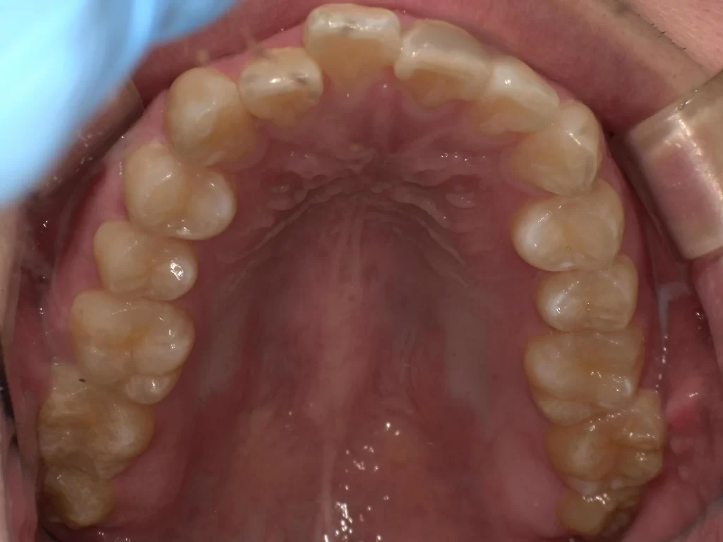 Altタグ: 北広島市 マウスピース矯正 アソアライナー 出っ歯 叢生 治療前 上顎
