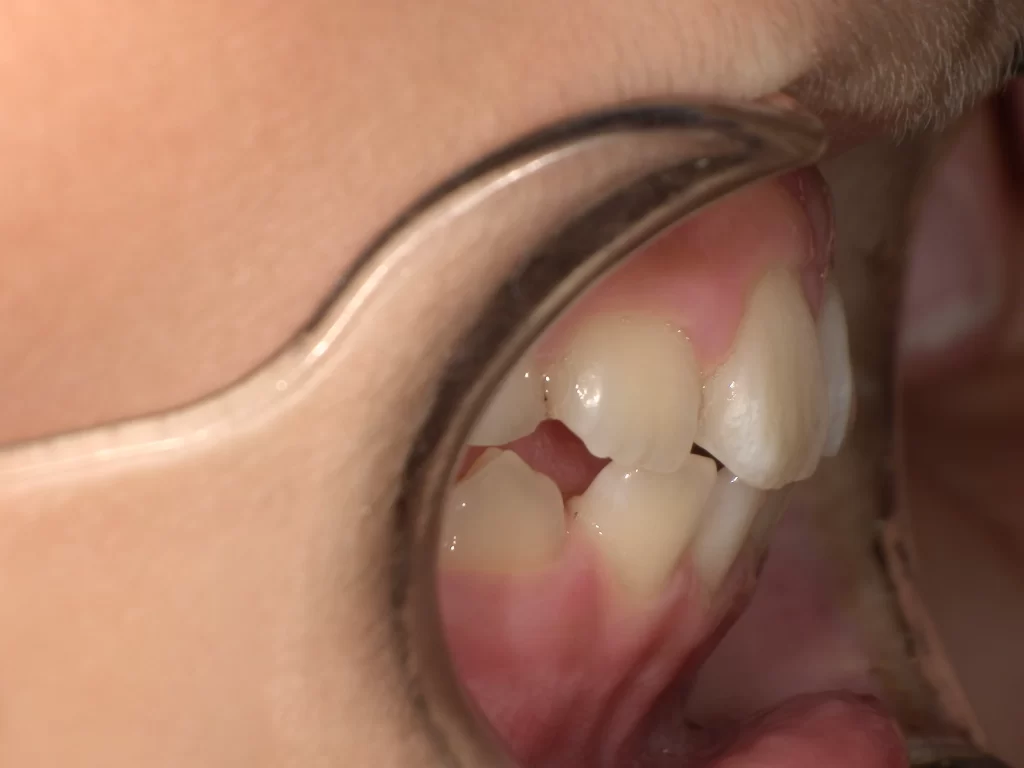 北広島市 プレオルソ 3ヶ月経過 出っ歯改善 症例写真 横