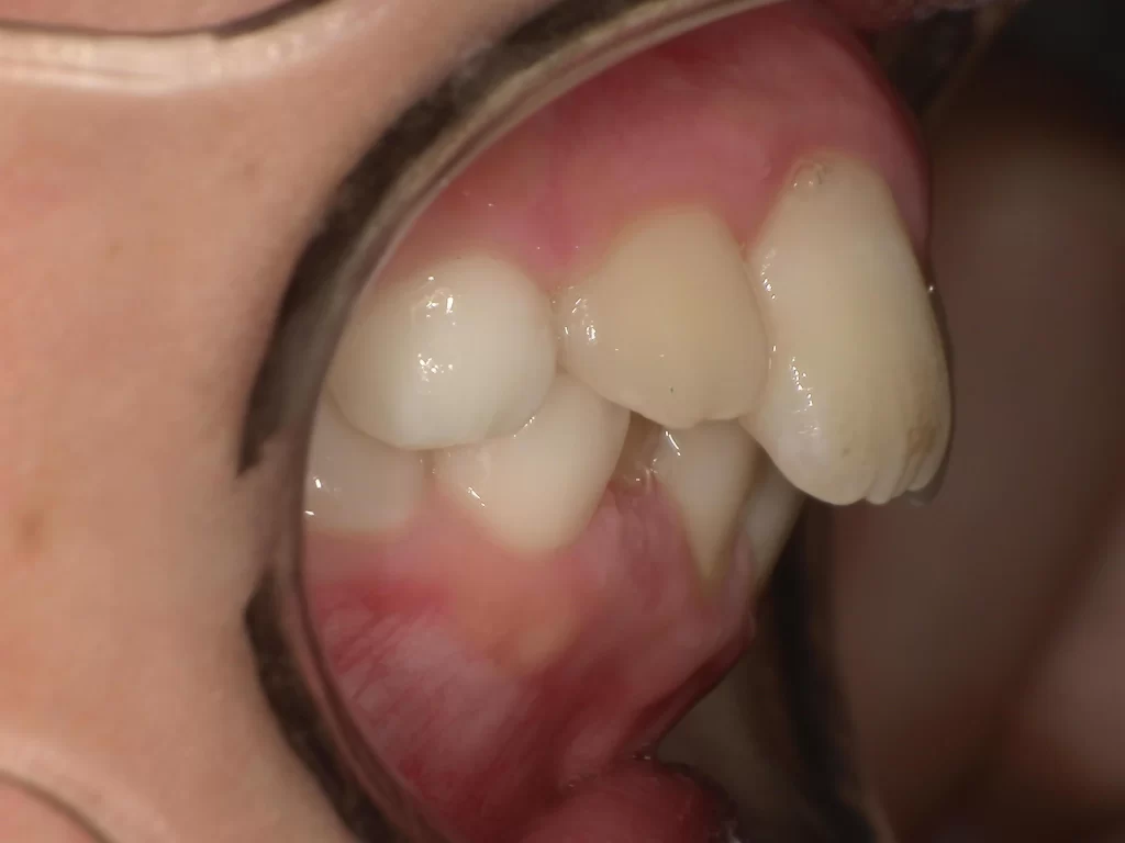 北広島市 子供の矯正 10歳 ガタガタ 出っ歯 治療前 横顔