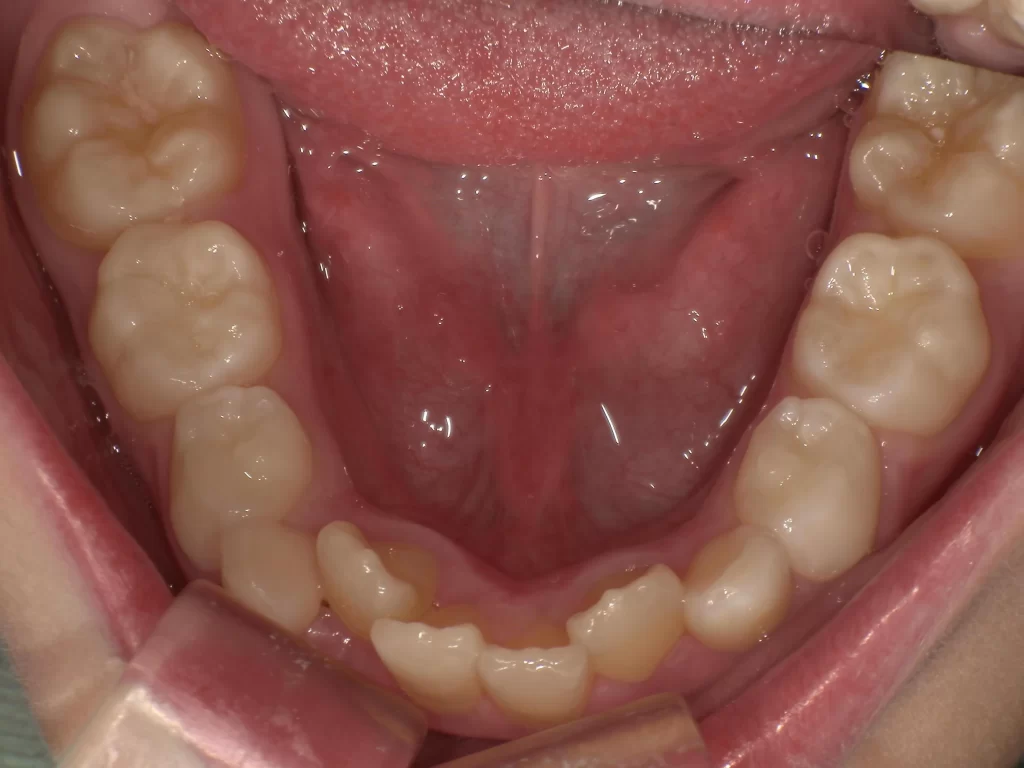 北広島市 小児矯正 叢生 治療前 下顎写真