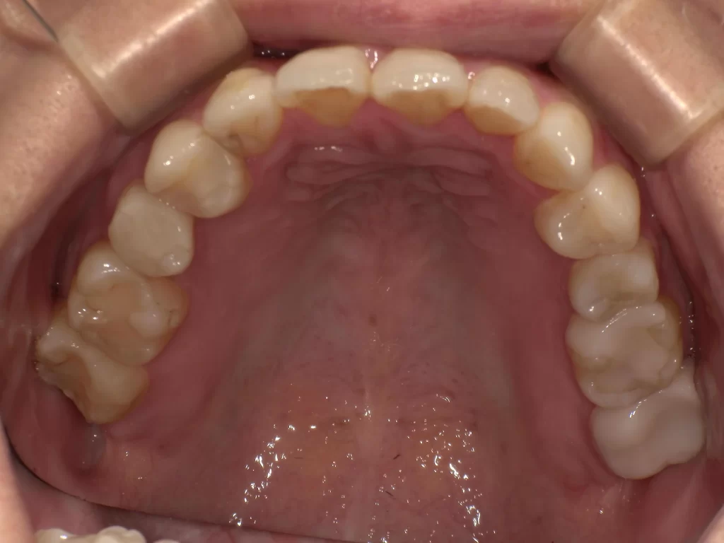 北広島市 部分矯正 症例アフター 期間10ヶ月 費用14万円 上顎