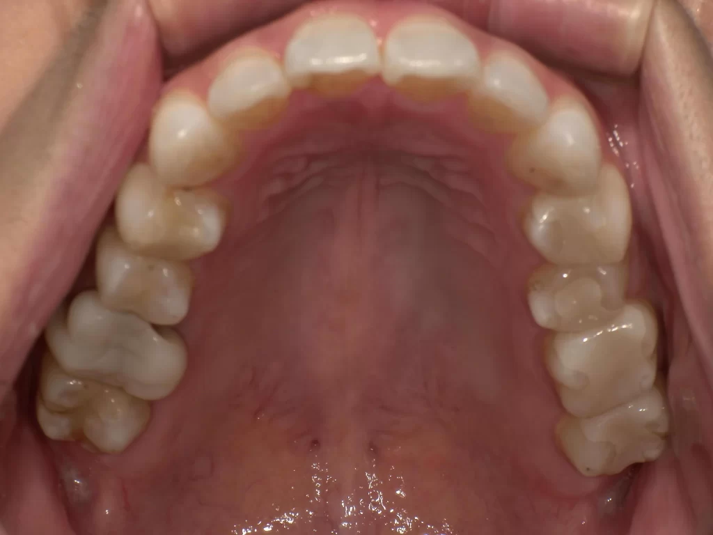 北広島市 アソアライナー 矯正途中経過 9ヶ月 上顎 歯列拡大