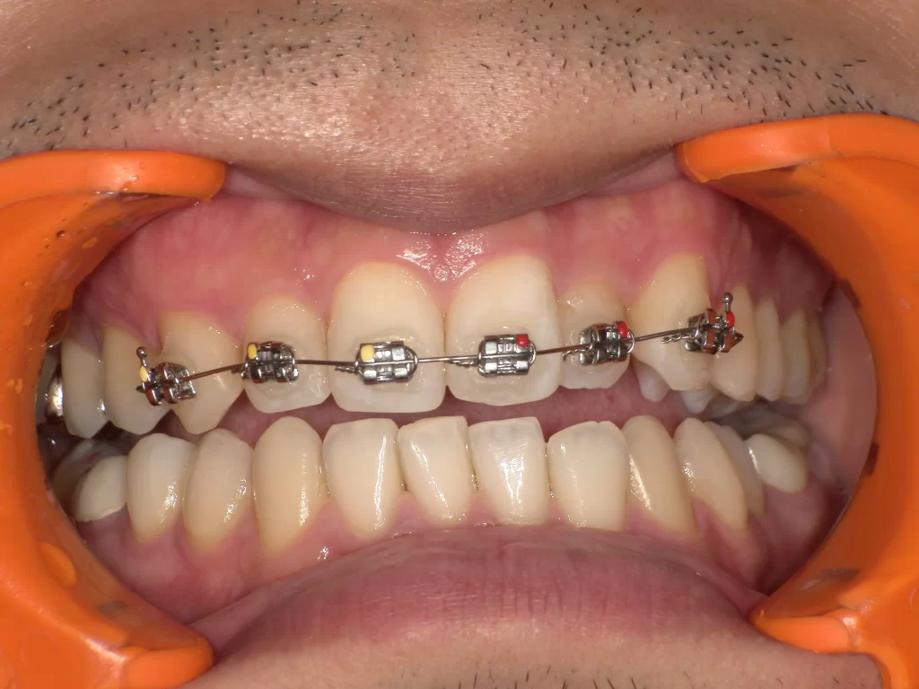 北広島市 矯正歯科 ワイヤー矯正 部分的 治療中写真