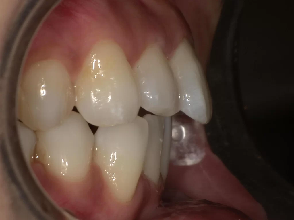 北広島市 矯正歯科 症例 横顔の変化 口元が閉じやすくなった状態