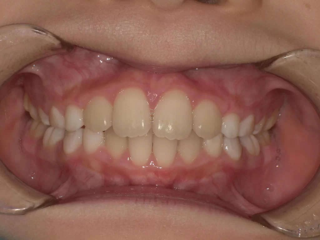 北広島市 小児矯正 ビフォーアフター ガタつき改善 正面